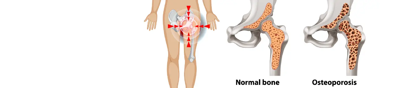 Osteoporosis pada Usia Produktif