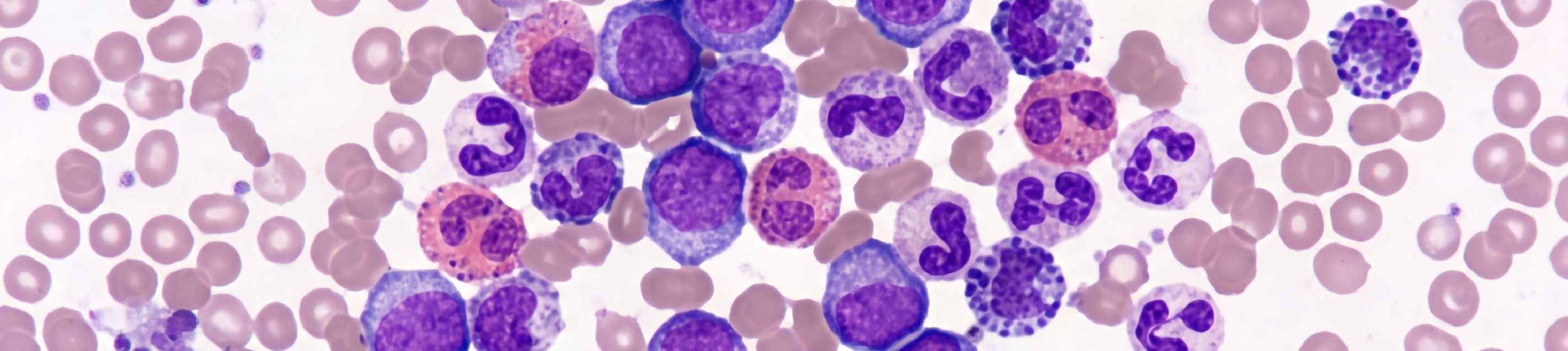 Leukemia Myeloid Kronis pada Anak