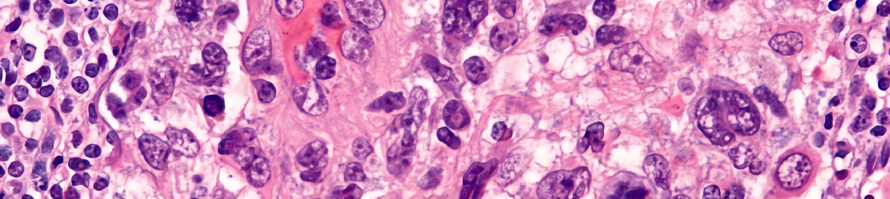 Limfoma Anaplastik Sel Besar