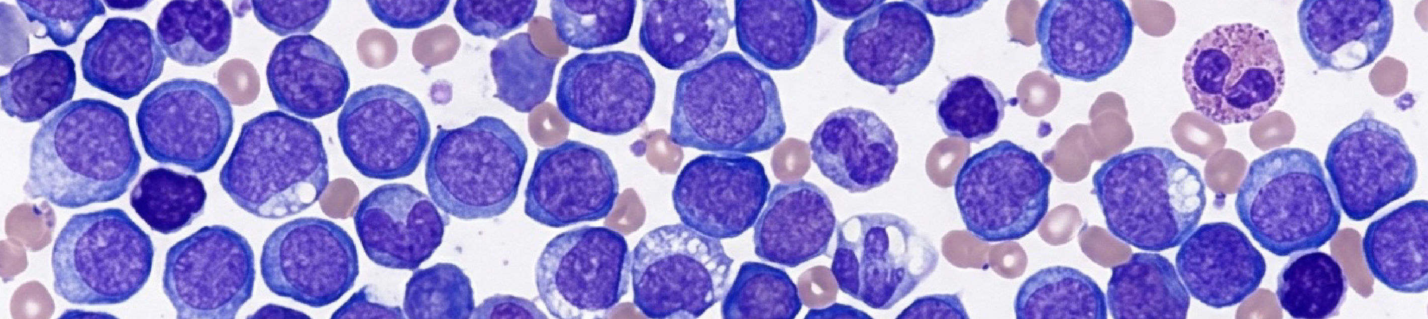 Leukemia Limfoblastik Akut (LLA)