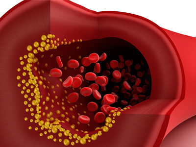 Kenali Kolesterol &amp; Cegah Risikonya