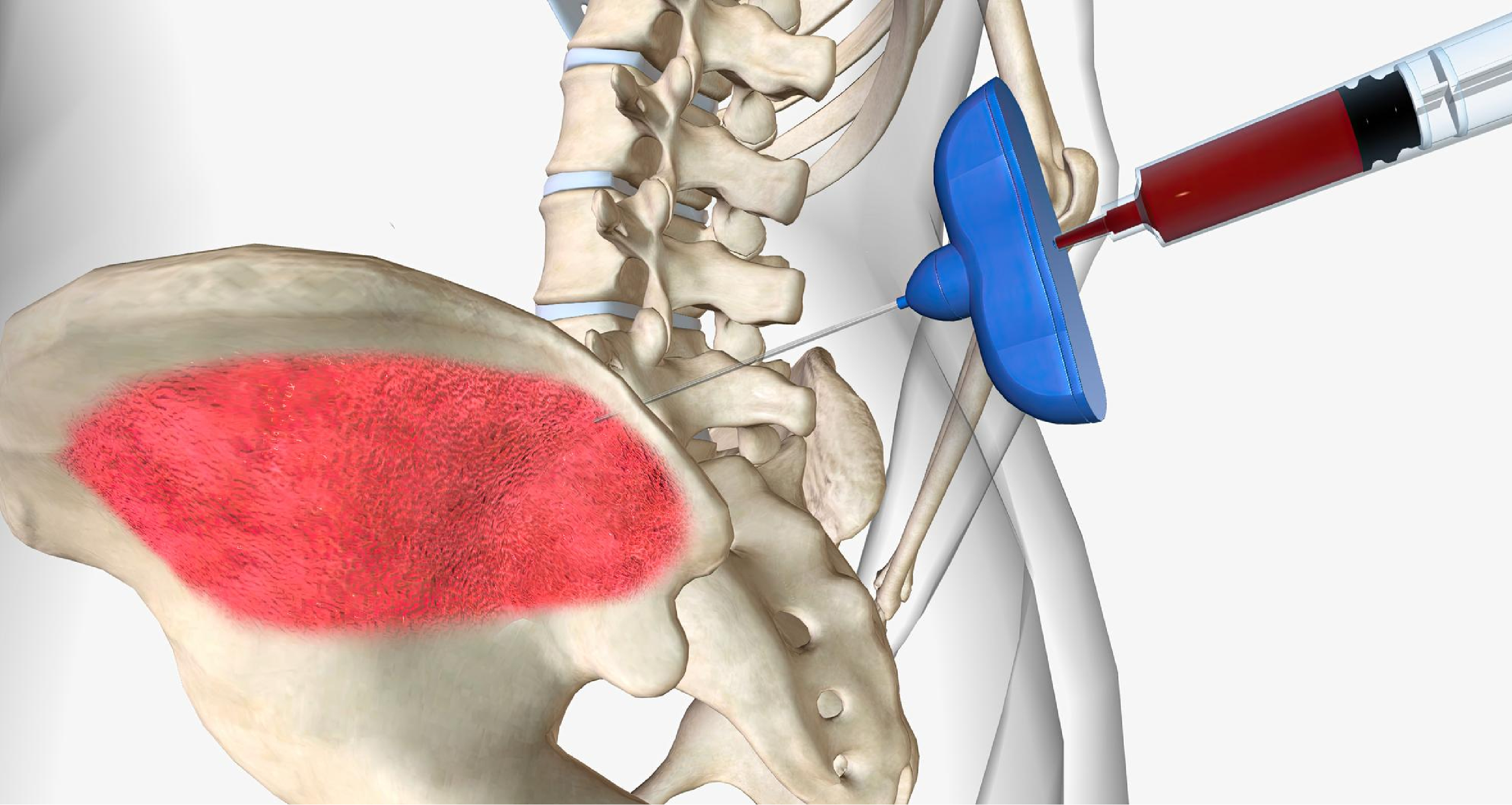 Tumor Sel Germinal