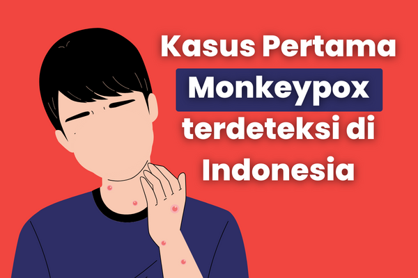 Kasus Pertama Monkeypox terdeteksi di Indonesia
