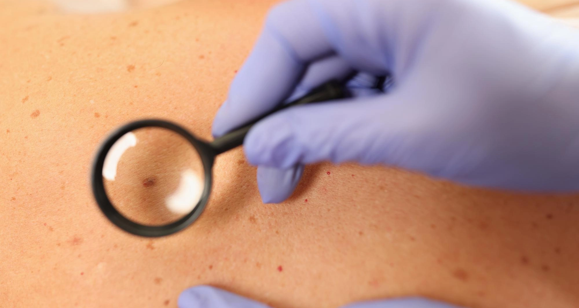 Melanoma pada Anak